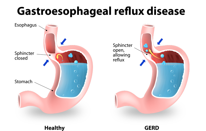 acid reflux