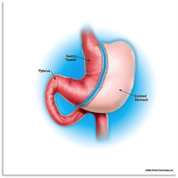 Gastric Sleeve (Sleeve Gastrectomy) Surgery