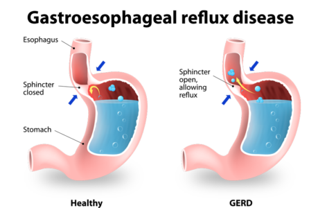 Acid Reflux & GERD Treatments