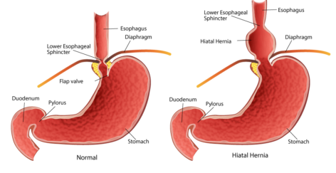 Surgery for large hiatus hernia